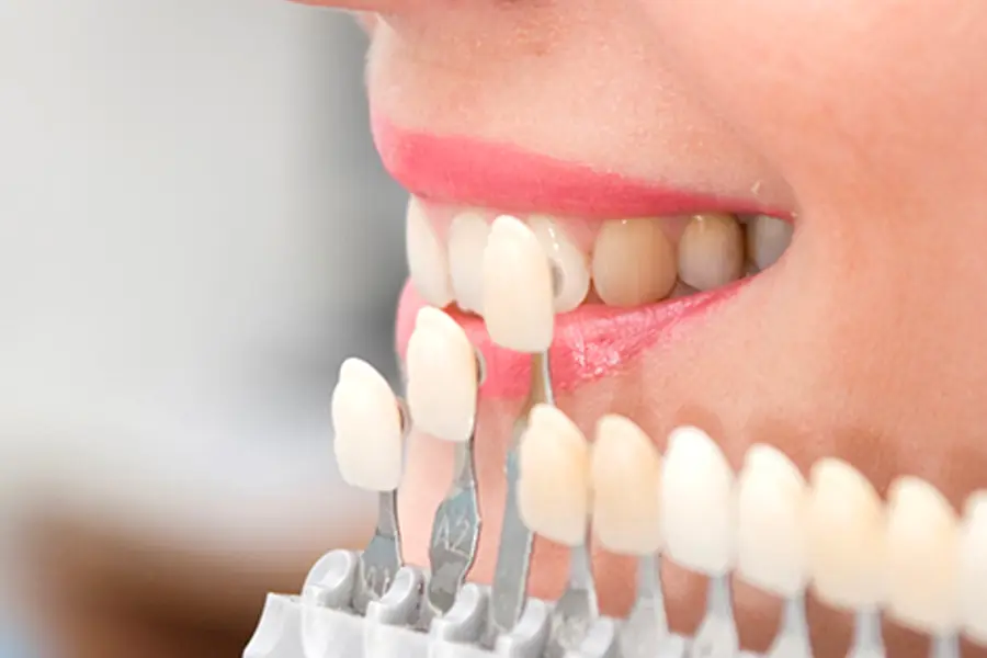 An image of a person smiling with veneers being held to their teeth so that the dentist in Bicester Dental can choose the best colour.