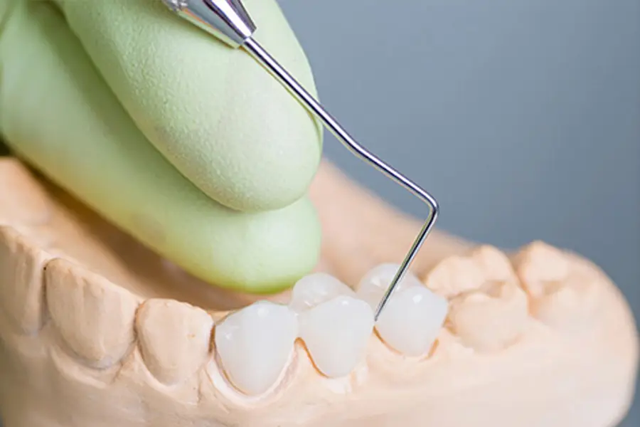 A dentist setting a dental bridge into a mouth.