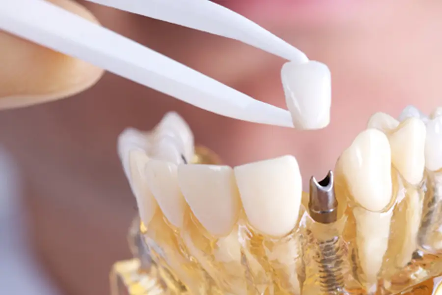 A tooth being placed on a dental implant by the Bicester Dental dentists.